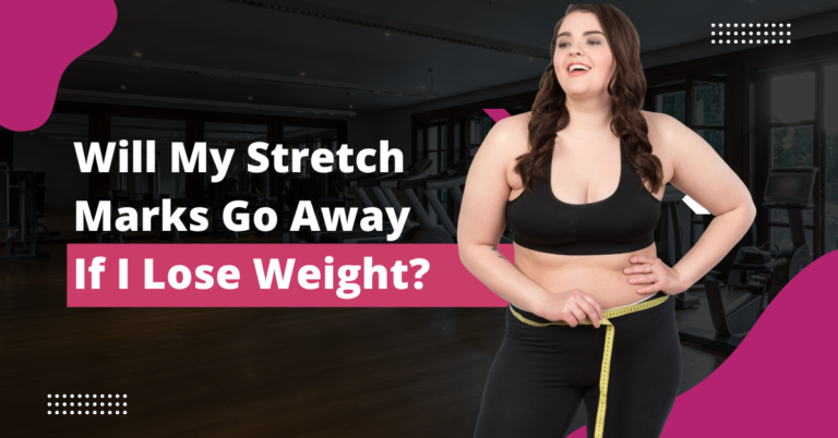 Will My Stretch Marks Go Away If I Lose Weight? Here Are The Most Realistic Answers